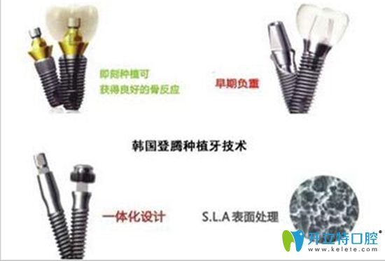 登騰種植牙價格合理效果不錯