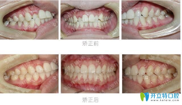 焦作拜博口腔個別牙齒反頜矯正案例