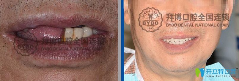 拜博口腔全口牙即刻負重種植案例前后效果對比