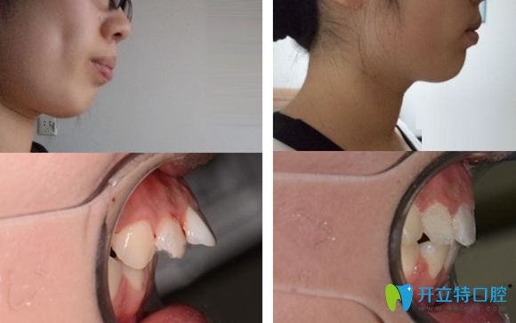 濟南韓氏口腔牙齒矯正改善突嘴暴牙案例效果圖