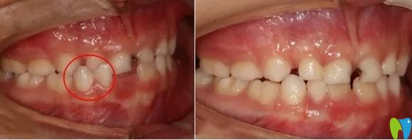 樂山英美口腔MRC肌功能矯正案例效果