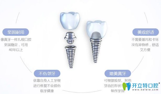 種植牙優(yōu)勢圖