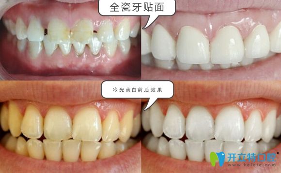 濟南韓氏口腔全瓷牙貼面和冷光美白效果圖