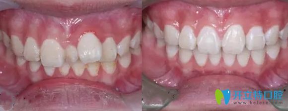 樂山英美口腔青少年多生牙正畸案例效果