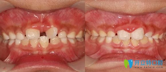 樂山英美口腔兒童扭轉牙矯正效果圖