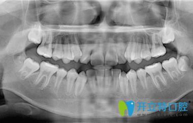 我在深圳正夫口腔做牙齒矯正前拍片 我在深圳正夫口腔做牙齒矯正前拍片