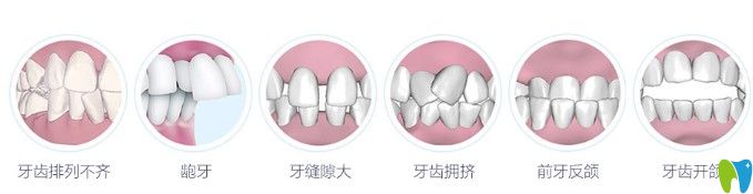 哪些牙齒情況需要做矯正圖示