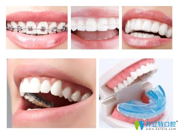 維嘉口腔的矯正方式圖