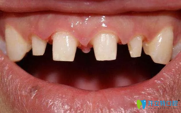 7天快速矯正牙齒方法美容冠