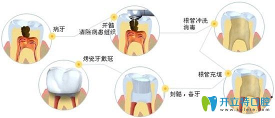 昆明尚愛韓美口腔盧玉瑩介紹根管治療的優(yōu)勢(shì)