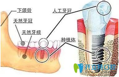 常用的人工種植牙技術(shù)有哪些？請看種植牙技術(shù)排名	