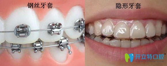 想做正畸又不想戴鋼絲牙套,那么隱形牙套矯正可能正合你意