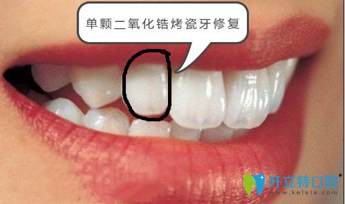 單顆二氧化鋯烤瓷牙修復(fù)效果