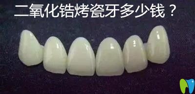 二氧化鋯烤瓷牙多少錢?價格800元一顆貴嗎?