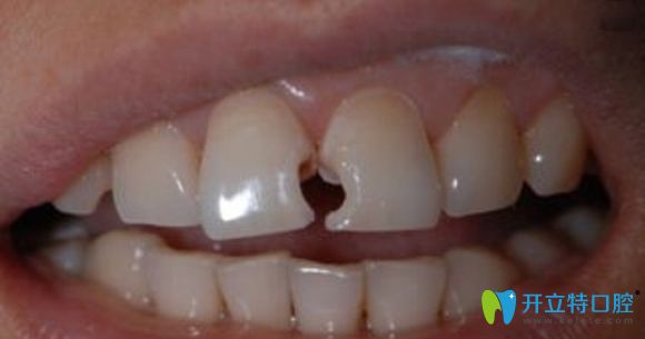 牙體缺損修復(fù)方式中樹脂貼面與全瓷牙貼面你會寵愛哪個(gè)?