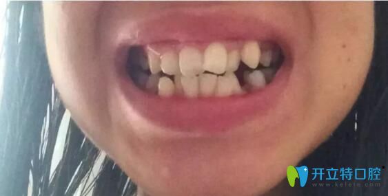 在武漢華美矯正擁擠不齊的牙齒時我還懷孕了，現(xiàn)已下牙套