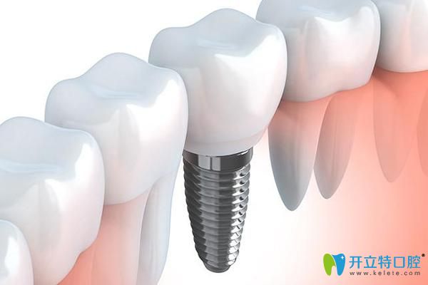 寧波恒美口腔徐路路科普種植牙術后注意事項