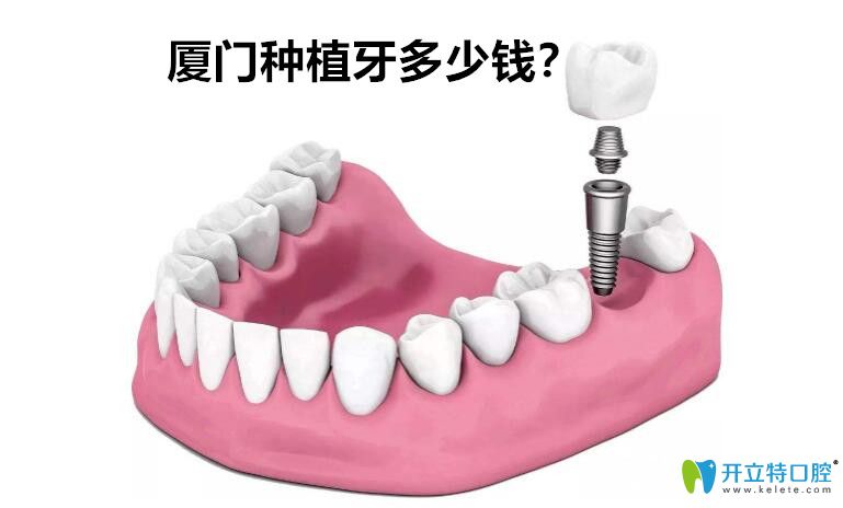 廈門種植牙多少錢？剛整理的廈門種植體品牌價格表供參考