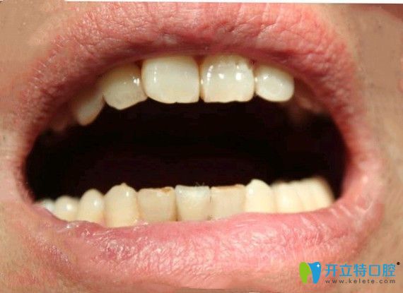 我在寧波恒美口腔做即刻種植牙后