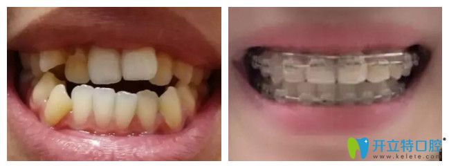 青島維樂(lè)口腔半隱形陶瓷托槽矯正案例