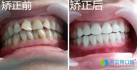 <!--<i data=20240703-sp></i>-->口腔牙齒擁擠矯正案例