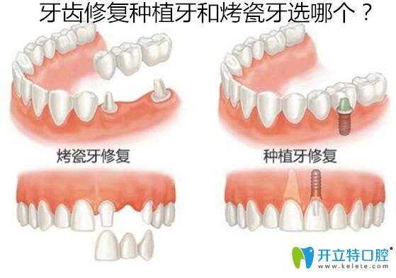 18歲缺失牙齒修復種植牙和烤瓷牙選哪個？