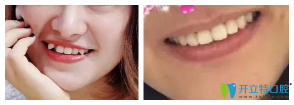 青島諾德口腔虎牙矯正案例