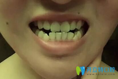 武漢仁愛口腔武漢牙齒矯正哪家醫(yī)院好?仁愛口腔潘少群正畸技術就很靠譜