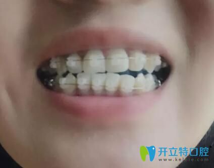 <!--<i data=20240703-sp></i>-->口腔潘少群給我做牙齒矯正第6個月