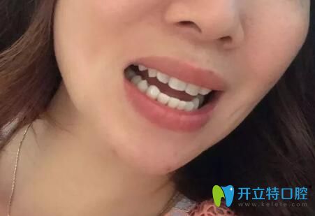 我在<!--<i data=20240703-sp></i>-->口腔做牙齒矯正后效果