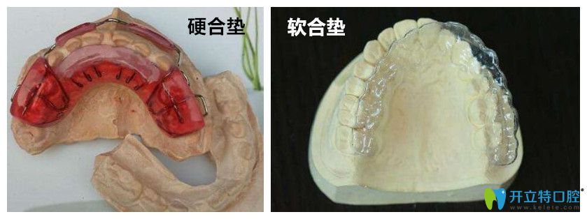 顳下頜關(guān)節(jié)紊亂采用頜墊進(jìn)行治療