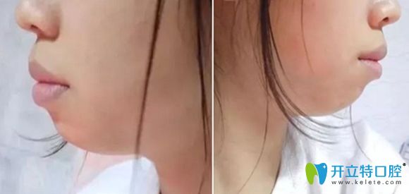 我的齙牙引起突嘴的側(cè)面照