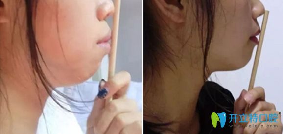 齙牙矯正前和矯正一年后的對比效果圖