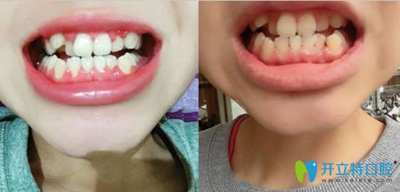 問:寧波慈溪哪里矯正牙齒好?答:鼎植口腔牙齒正畸還不錯呦!