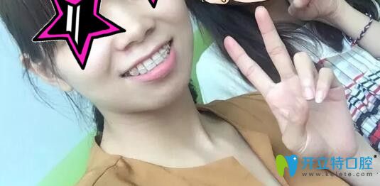 齙牙矯正過程中打骨釘內(nèi)收 齙牙矯正過程中打骨釘內(nèi)收