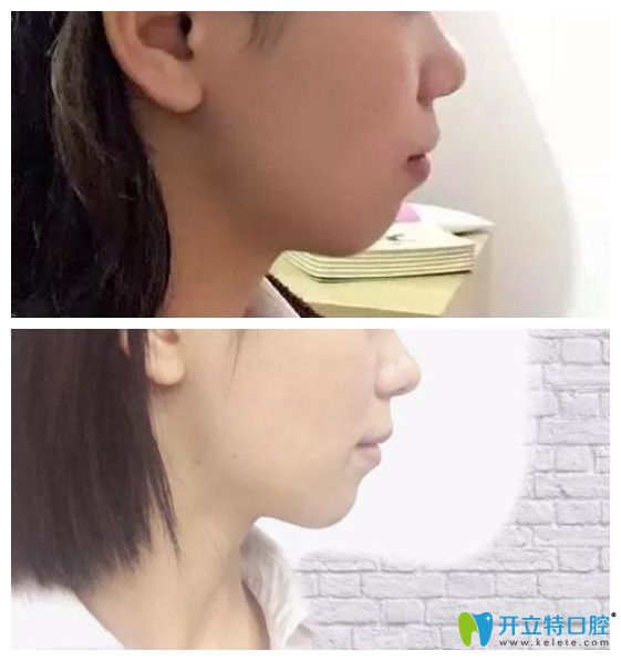 齙牙矯正前后側(cè)臉對比照片 齙牙矯正前后側(cè)臉對比照片