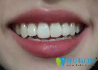 我在煙臺(tái)百仕口腔做牙齒矯正1年半 我在煙臺(tái)百仕口腔做牙齒矯正1年半