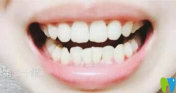 我在煙臺(tái)百仕口腔做牙齒矯正10個(gè)月 我在煙臺(tái)百仕口腔做牙齒矯正10個(gè)月