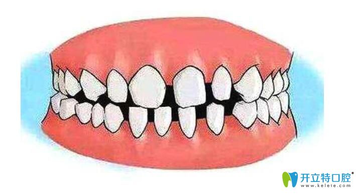 銘德口腔劉建林醫(yī)生告訴你：有牙周炎能做牙齒矯正嗎