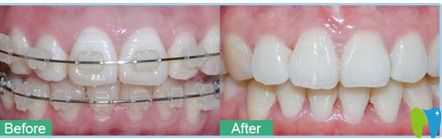 在深圳鵬程口腔林小姐做的陶瓷矯正前后對(duì)比圖