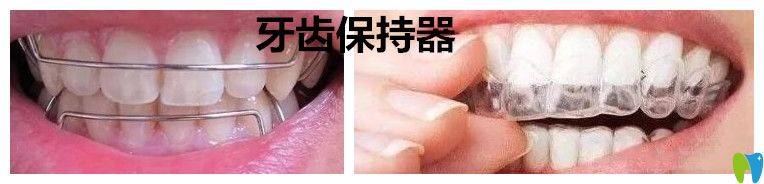 成人牙齒矯正后戴好保持器就不會(huì)反彈