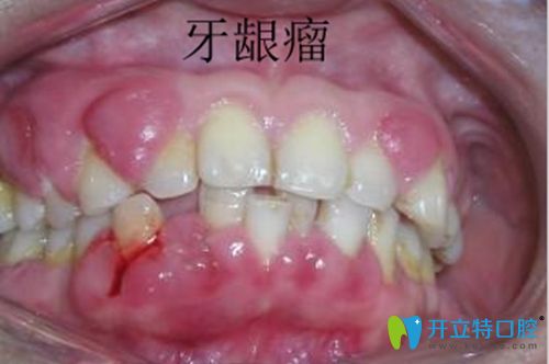 好怕怕!妊娠期牙齦瘤怎么控制?是不是腫瘤？