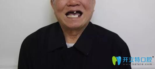 87歲老人讓廣州柏德口腔薛啟明做了半口種植牙后來談感受