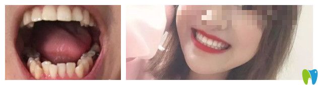 看30歲老阿姨骨性齙牙在揭陽華美拔了4顆牙的矯正之路