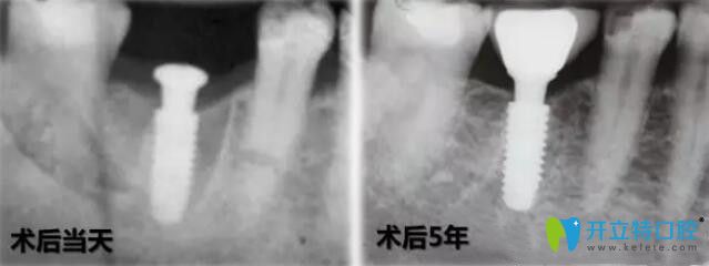 法國(guó)安卓健種植牙穩(wěn)定性強(qiáng)