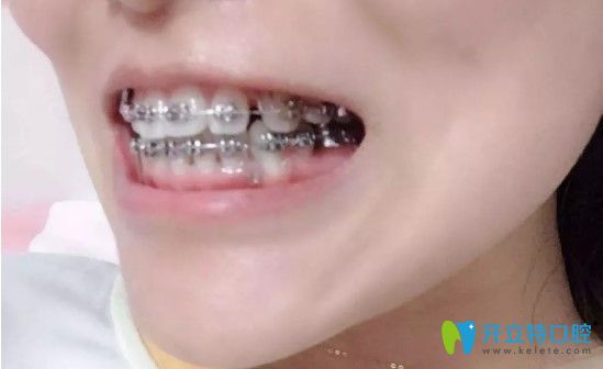 牙齒矯正9個多月圖片 牙齒矯正9個多月圖片