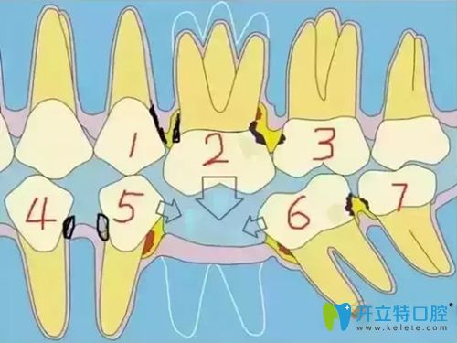 不得不說,缺一顆牙齒的危害比你想象中要厲害得多！