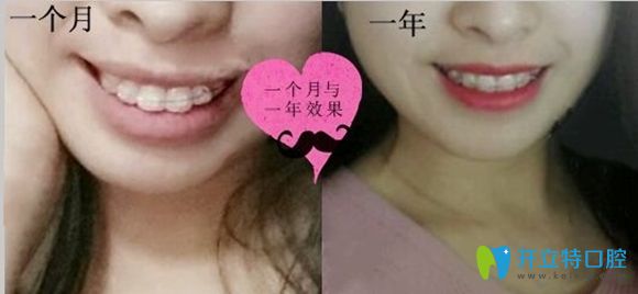 深圳潤(rùn)澤瑞尼絲口腔齙牙矯正前后效果圖