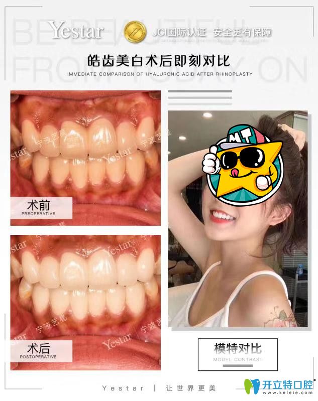 藝星口腔皓齒美白案例前后效果對比
