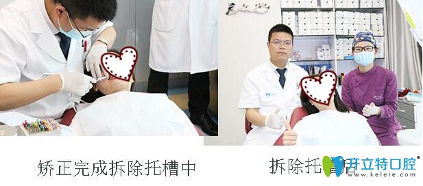 在深圳格倫菲爾口腔做半隱形矯正2年拆牙套 在深圳格倫菲爾口腔做半隱形矯正2年拆牙套